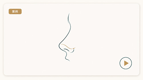 Micro hump nose case video| Analysis of Dr. Long Chengyun's advanced nose shape to preserve the sense of bone